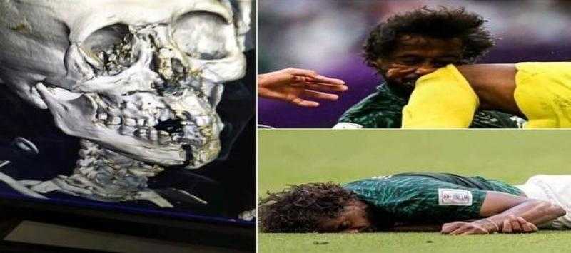 طبيب المنتخب السعودي: مسيرة «الشهراني» الكروية انتهت رسميا