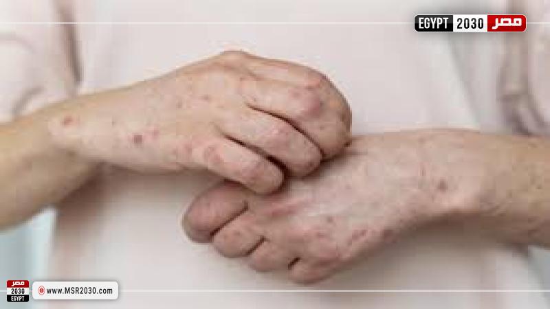 جدرى القرود