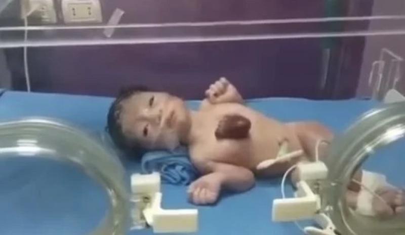 «معجزة إلهية».. استقبال أول مولود بقلب خارج القفص الصدري