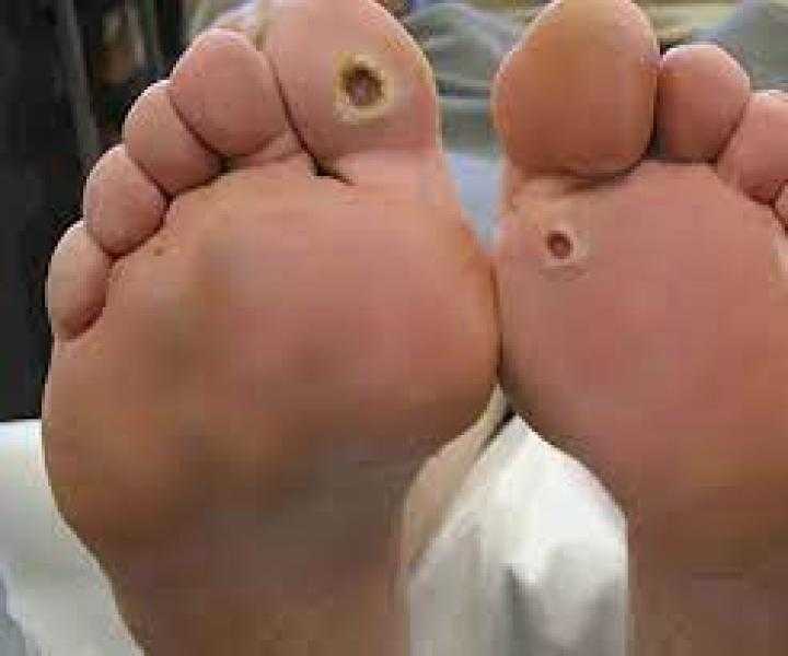 لأول مرة في مصر.. استخدام ”مشيمة الولادة” لعلاج أمراض جلدية والقدم السكري (تفاصيل)