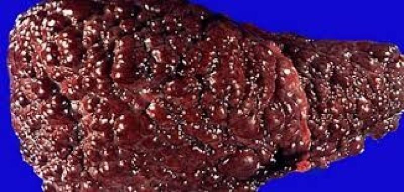 أسباب تؤدي إلى الإصابة بالتليف الكبدي