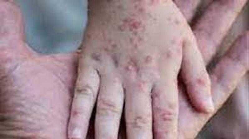 الصحة عن ظهور أول مصاب بجدري القرود: كان مخالطًا لحالة بالخارج.. فيديو