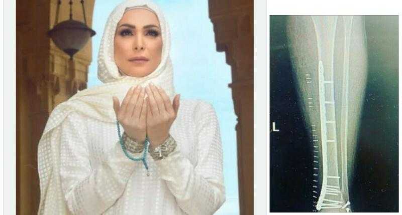 ركبوا أسياخ في رجلها.. تفاصيل الحالة الصحية لـ أمل حجازي