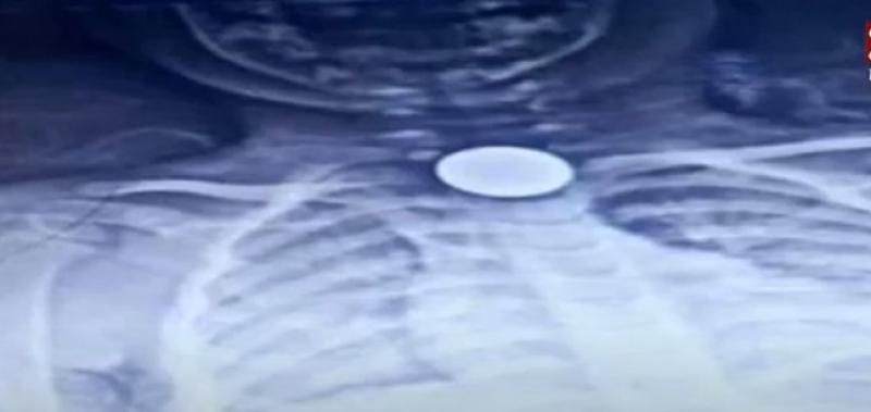 تفاصيل إنقاذ طفل عمره 3 سنوات من الموت بعد ابتلاعه عملة معدنية بالسويس.. «فيديو»