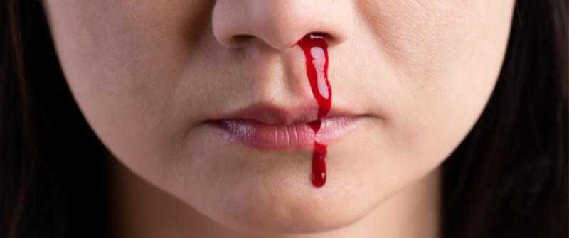 نصائح مهمة للتعامل مع حالات نزيف الأنف.. «فيديو»
