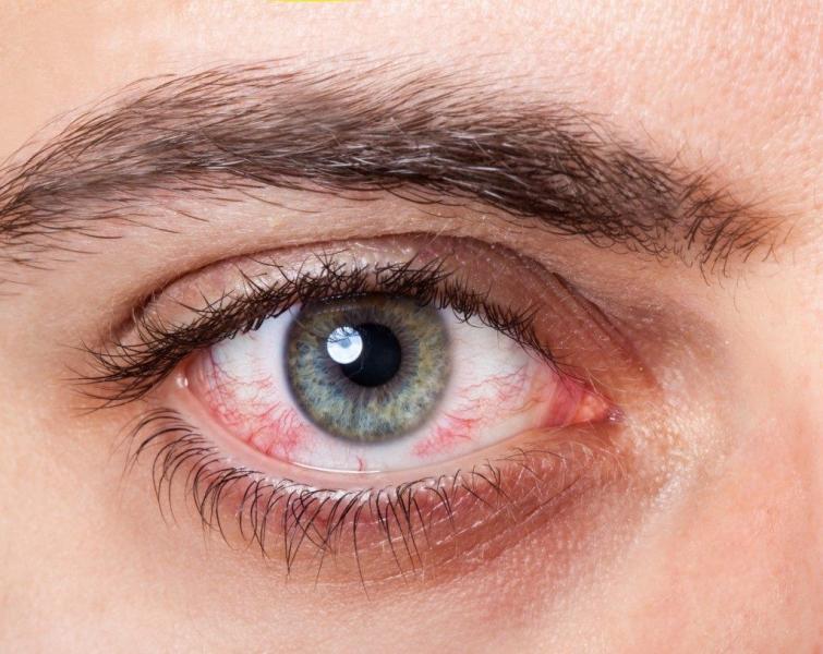 احذر.. هذه الأعراض تشير لإصابتك بحساسية العين «فيديو»