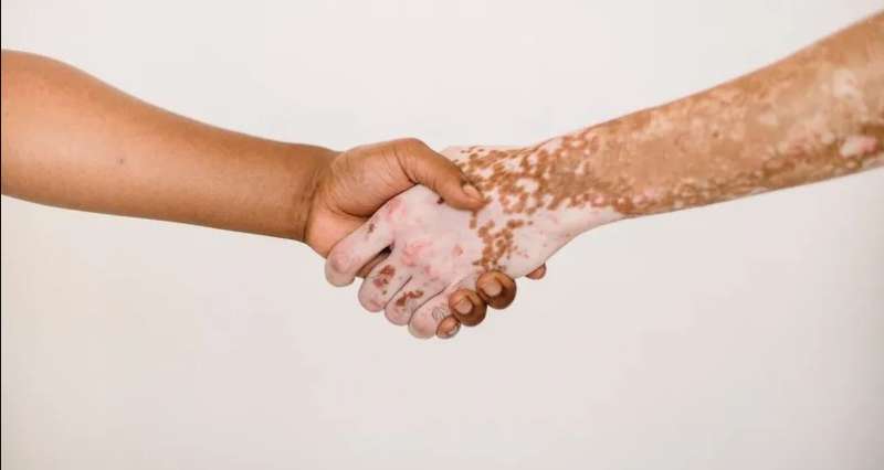 مرض البهاق