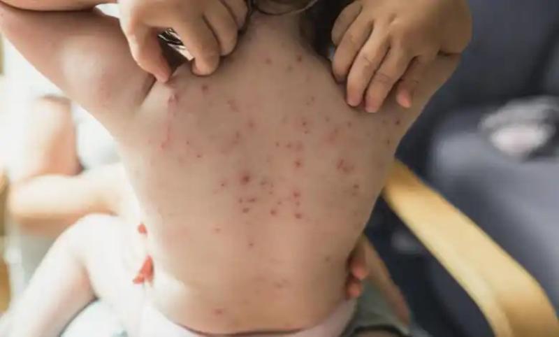 طبيب يوضح أعراض الإصابة بالجدري المائي للأطفال