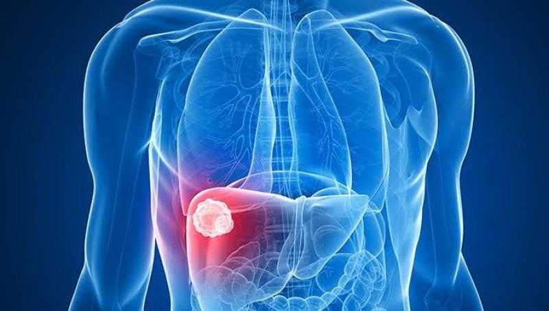 هل تسبب الوفاة؟.. حسام موافي يكشف أسباب غيبوبة الكبد وطرق الوقاية