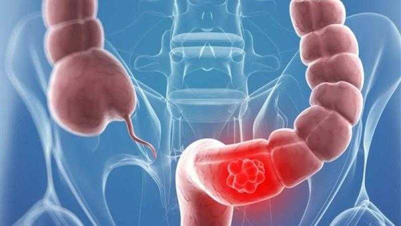 حسام موافي لـ مريض القولون: تشخيصك بـ 3 طرق فقط