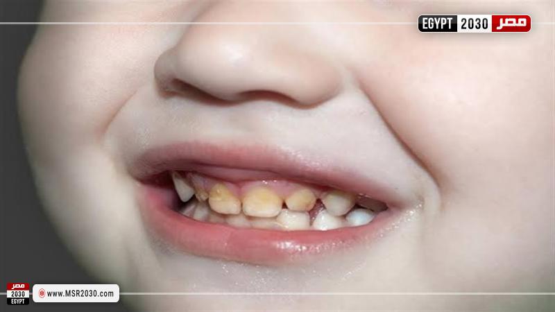 إصفرار أسنان الأطفال
