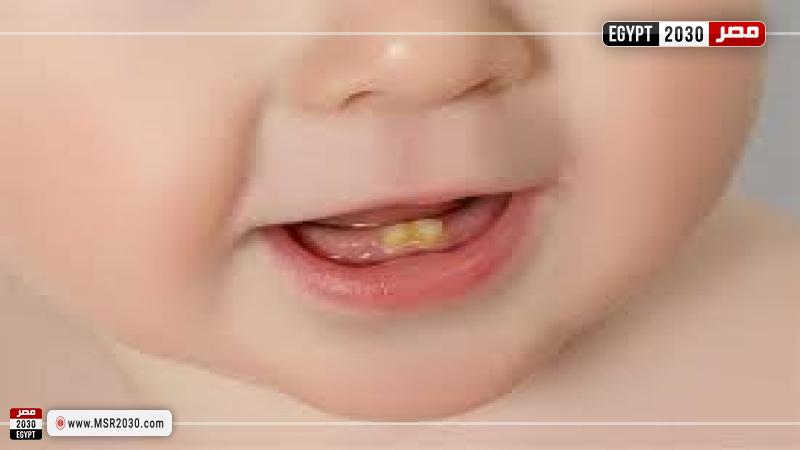 اصفرار الأسنان