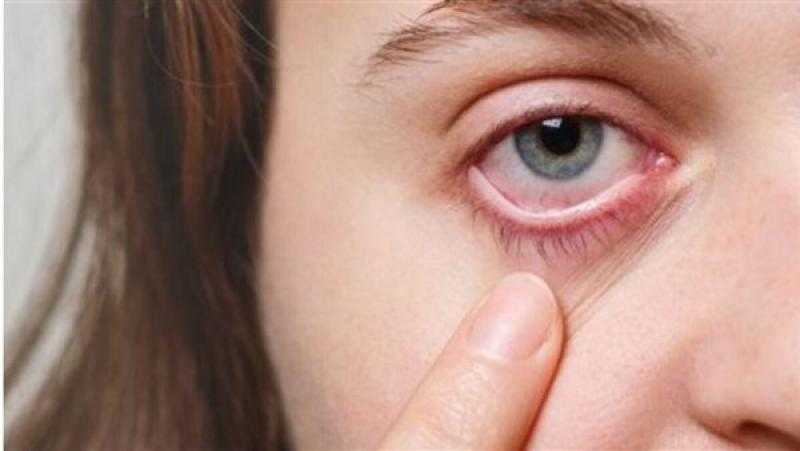 علامات تكشف إصابتك بارتفاع الكوليسترول في الدم