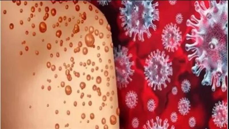 الصين تسجل 305 إصابات مؤكدة بفيروس جدري القرود