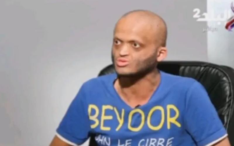 شاب يعاني من «مرض السحلية» يواجه التنمر ويطالب بالاحترام