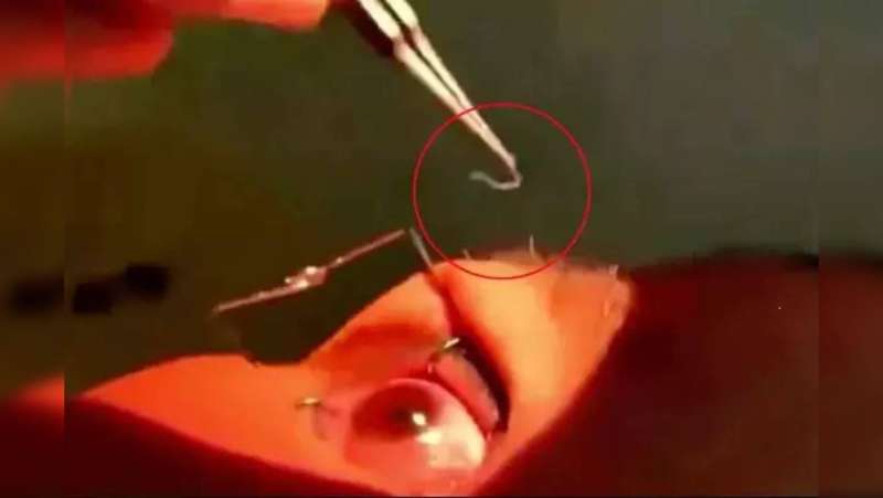 استحراج 60 دودة حية من عين امرأة