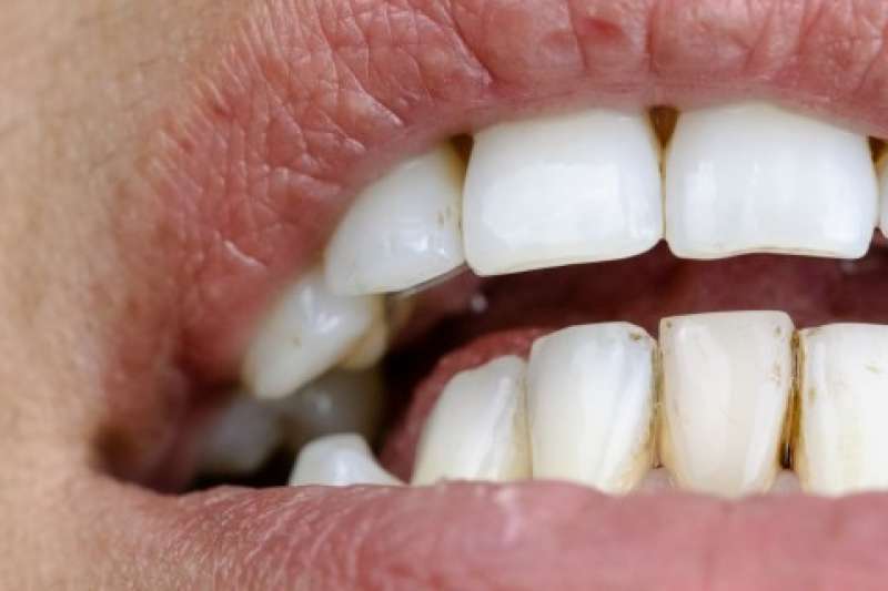ظهور بقع سوداء على الأسنان