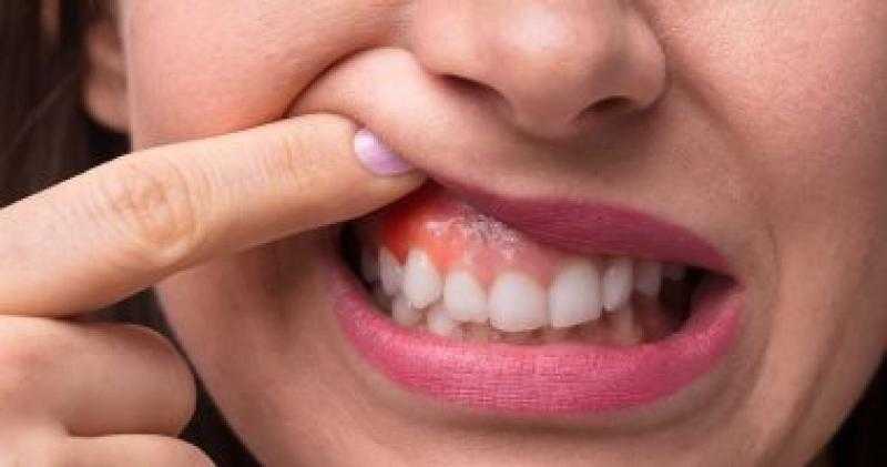 تعرف على أعراض سرطان تجويف الفم