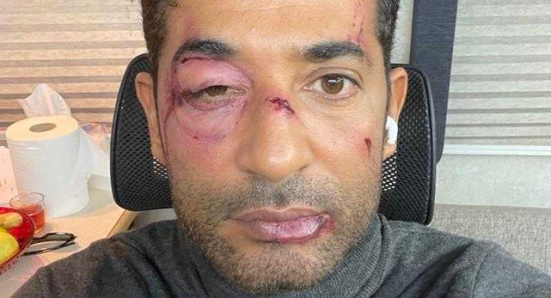عمرو سعد يثير حيرة جمهوره بكدمات وجروح في وجهه (صورة)
