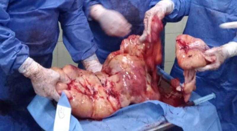 يزن 15 كيلو.. استئصال «ورم ضخم» من مريضة بمستشفى فاقوس المركزي