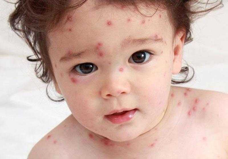 تعليم المنوفية: ظهور حالات ”جدري الماء” بمدرسة الباجور خفيف ولا يمثل خطورة