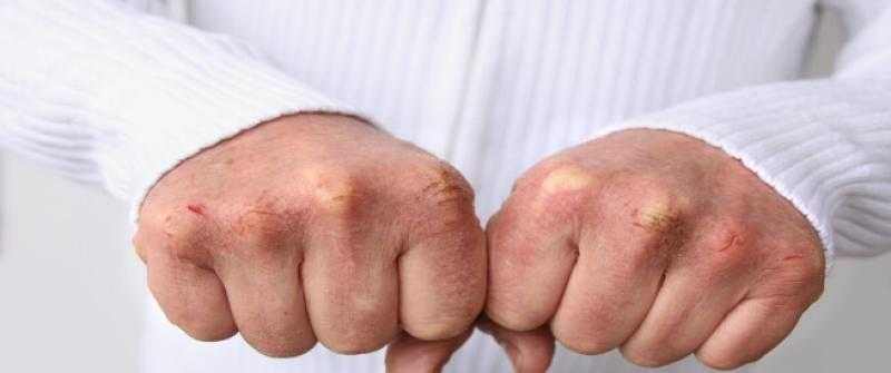 تحذير للنساء.. استشاري يكشف أسباب التشققات الجلدية.. «فيديو»