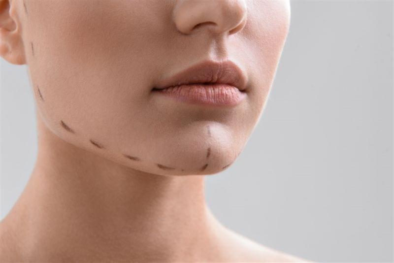 إزالة الذقن