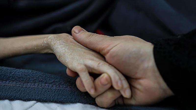  وفاة طفل جراء سوء التغذية في غزة