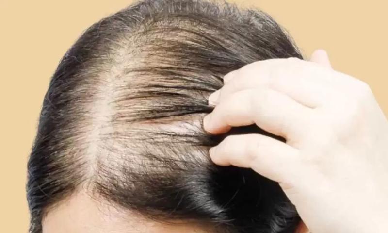 تساقط الشعر 