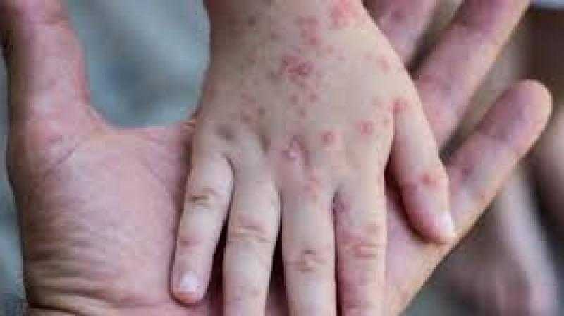 انعقاد الاجتماع الخامس للجنة الطوارئ لتقرير وضع جدرى القرود بالعالم