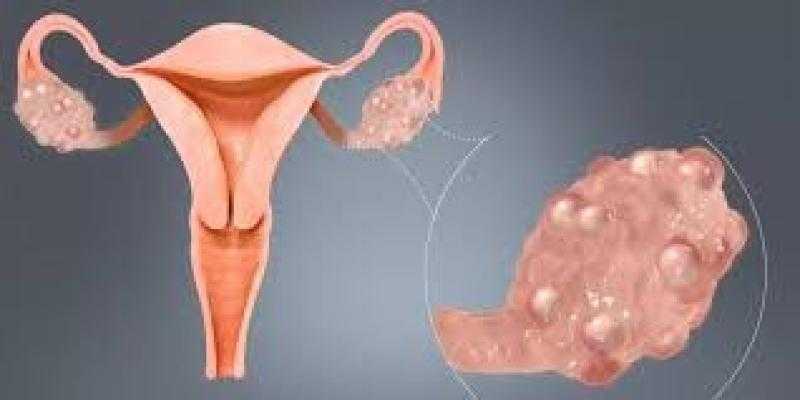 أطعمة تساعد على علاج تكيس المبايض