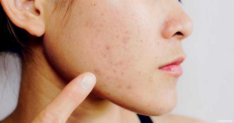 وصفات طبيعية لعلاج البقع الداكنة