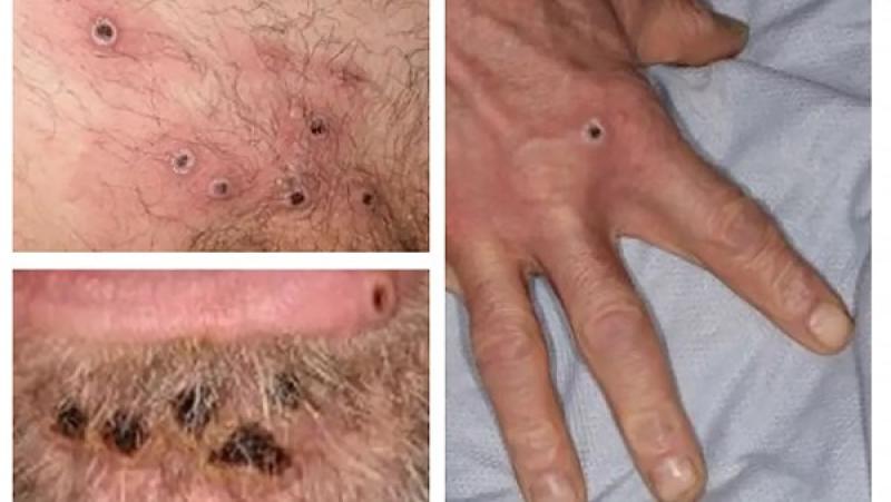 فيروس جدري القرود في أفريقيا