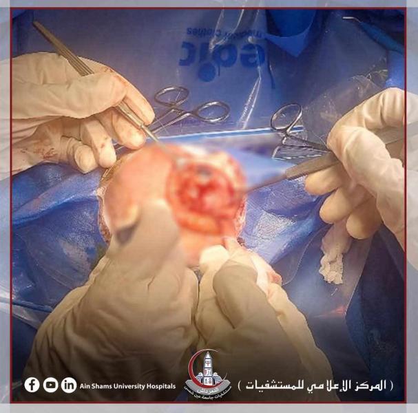 نجاح استئصال ورم نادر من عين رضيعة عمرها يوم واحد بمستشفيات جامعة عين شمس