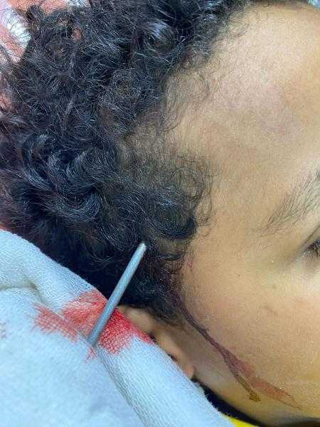 مستشفيات جامعة قناة السويس: جراحة دقيقة تنقذ طفلا من الموت بعد اختراق سيخ معدني لرأسه