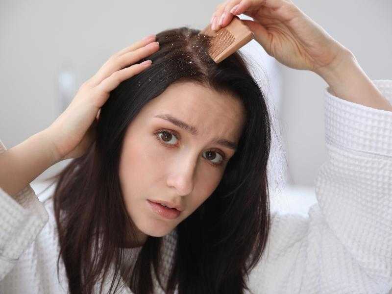 تخلصي من قشرة الشعر بهذه الخطوات