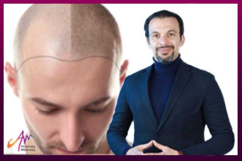 أفضل مركز لزراعة الشعر في مصر