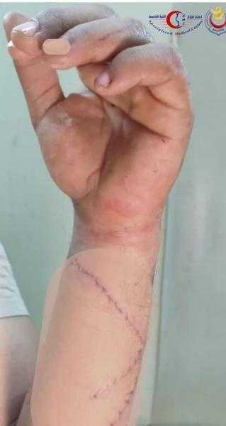 انقاذ ذراع شاب من البتر.. انجاز طبي جديد لمستشفى جراحات اليوم الواحد البساتين