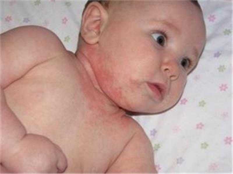 عشان فصل الصيف.. دليلك لحماية طفلك من حمو النيل