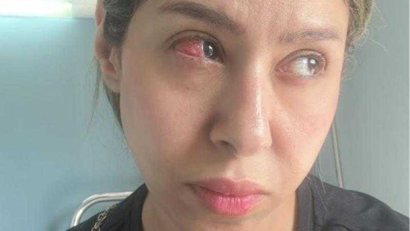 بسبب خطأ طبي .. إيناس عز الدين تكشف عن إجراء عملية عاجلة في عينها