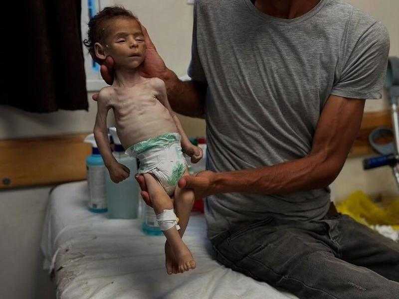 ارتفاع وفيات سوء التغذية في غزة وتحذيرات أممية من تفاقم الأزمة