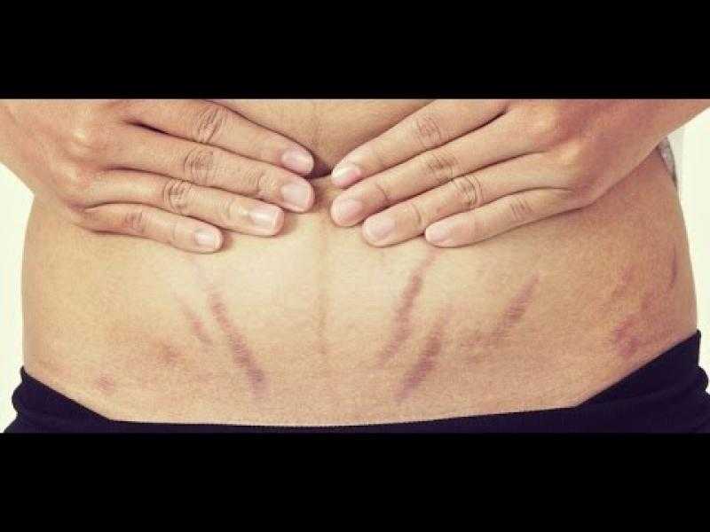 طرق منزلية لعلاجها.. كل ما تود معرفته عن علامات التمدد