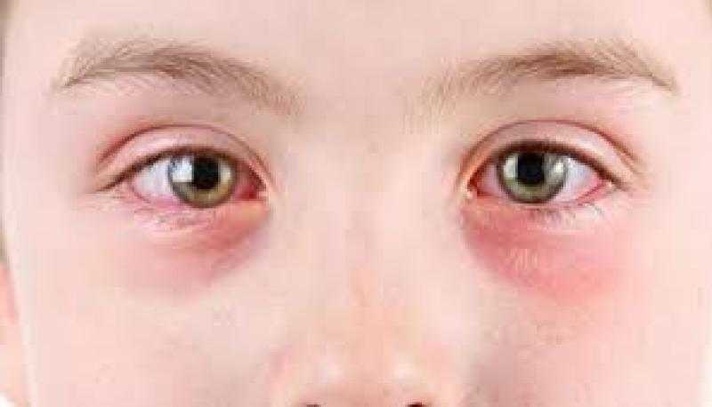 وزارة الصحة تُنفذ برنامجًا تدريبيًا للقضاء على التراكوما