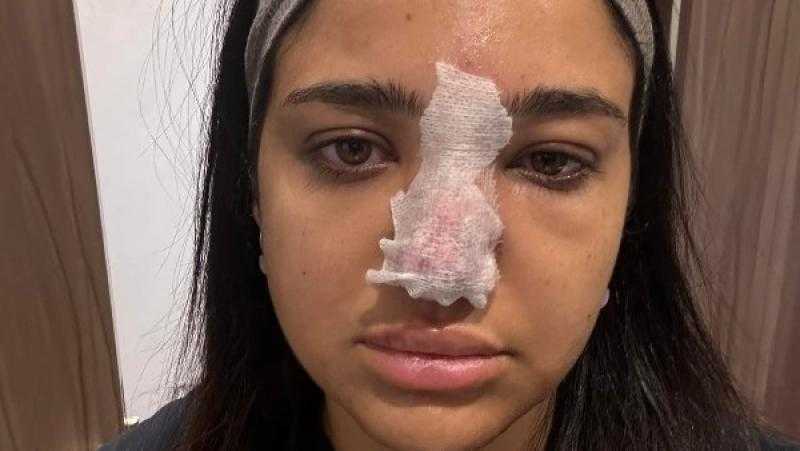 بعد كنزي مدبولي.. طبيبة تحذر من فيلر الأنف