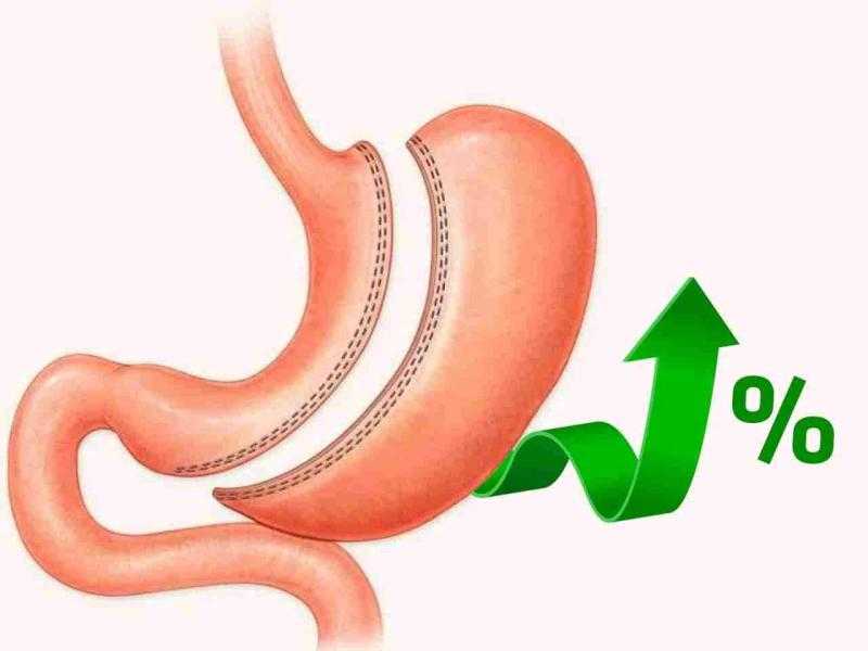 عملية تكميم المعدة | برنامج التغذية من السوائل إلى الصلب