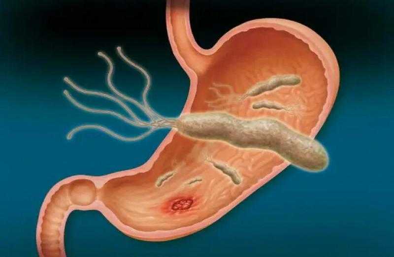 أطعمة ممنوعة أثناء علاج جرثومة المعدة