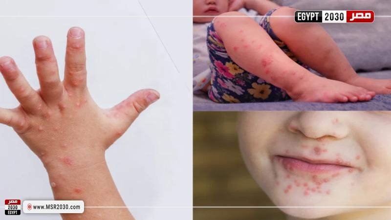 مرض اليد والقدم والفم