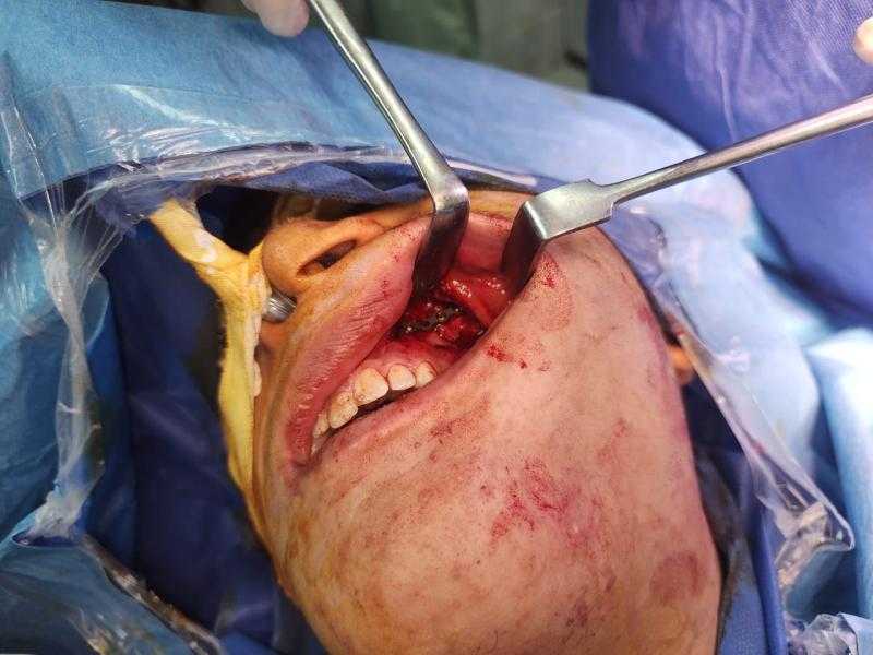 صحة الشرقية: إجراء ٣ جراحات وجه وفكين ذات مهارة بمستشفى الزقازيق العام