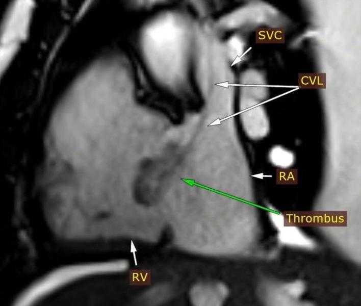 وحدة تصوير القلب بالرنين المغناطيسي بمستشفي سوهاج الجامعي الجديد تُشخّص حالة نادرة لمريض وتُسهم في علاجها الفوري