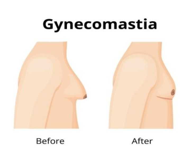 التثدي عند الرجال وعلاجه مع د.عمرو عادل مصطفى